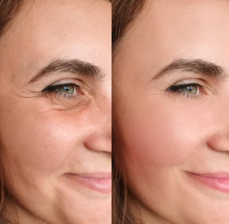 عکس فیشیال صورت قبل و بعد